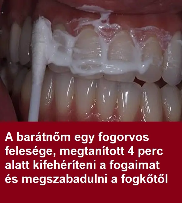 fogkő ellen